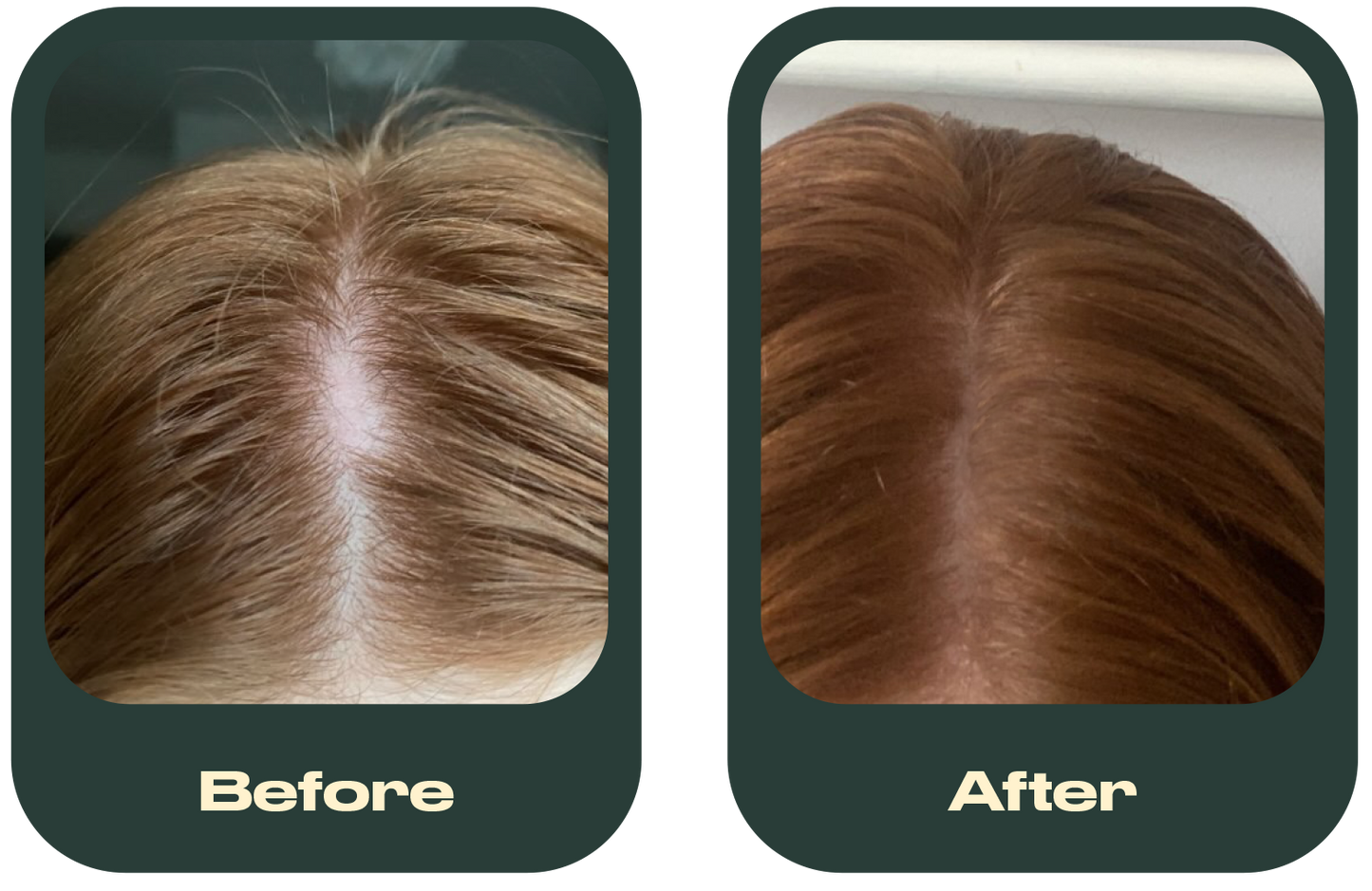 Grow it Ultimate hair bundle - 3 Months Hair supplements + Scalp oil + FREE €11 Microfibre hair towel
