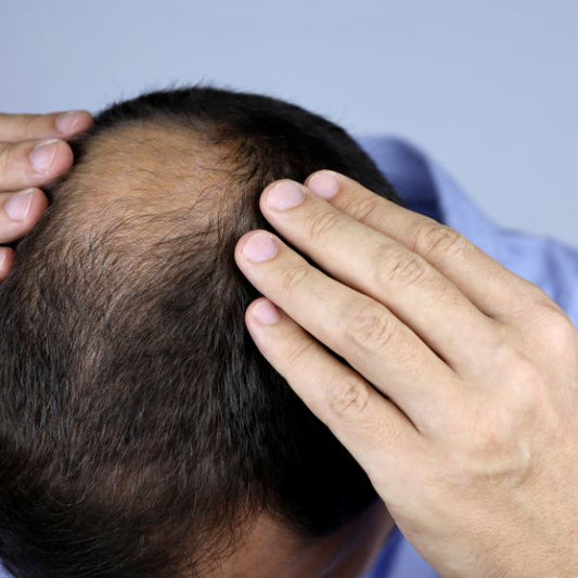 Natural Alternatives to Minoxidil for Healthy Hair Growth